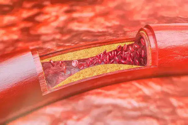 Inflammatory signaling begins when cells detect stress and release molecular signals that activate immune responses